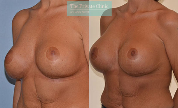 Breast Implant Removal Replacement - 064AR-RR-Side