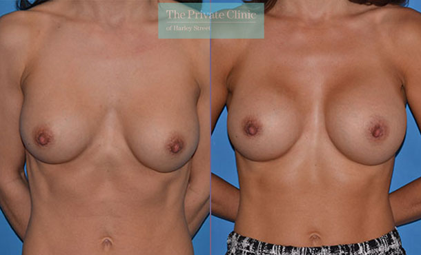 before and after photos of breast implant replacement