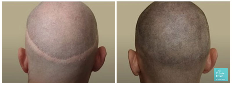 Best clinics for scalp micropigmentation in Lambeth, London