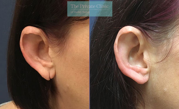 Split Earlobe Repair - 002P-MM