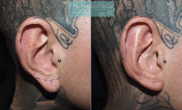 Split Earlobe Repair - 001P-MM-Left