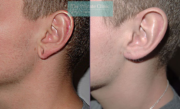 split stretched earlobes tribal ear repair before after photo results mr miles berry 017MB