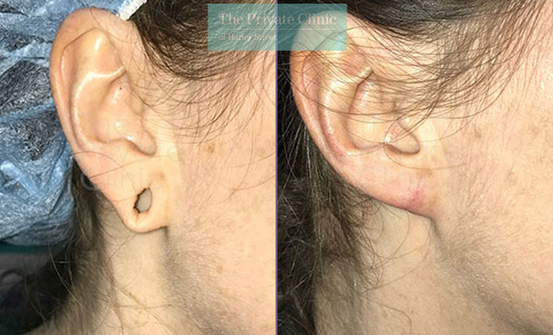 Tribal Earlobe Repair - 016MB