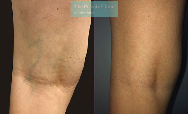 thread veins spider veins removal legs maria narsoomamode close 001MN