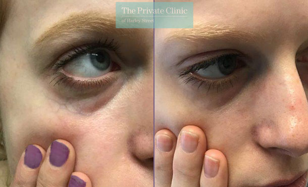 thread veins spider veins removal under eye veins maria narsoomamode left 003MN