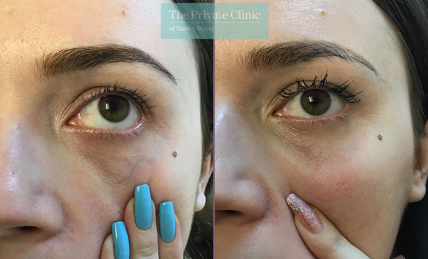 thread veins spider veins removal under eye veins maria narsoomamode right 002MN