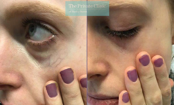 thread veins spider veins removal under eye veins maria narsoomamode right 003MN