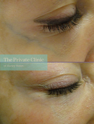 thread veins under eyes before after photo results private clinic 023TPC