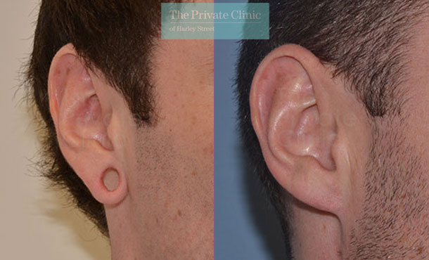 tribal earplug repair earlobes before after photo uk results mr miles berry 018MB