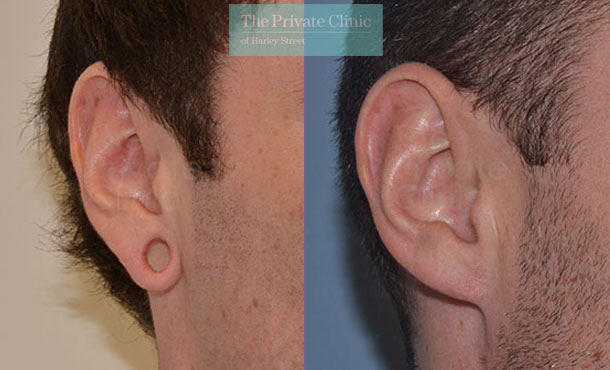 Tribal Earlobe Repair - 018MB