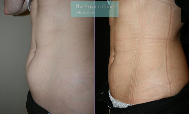 before and after photos of vaser lipo