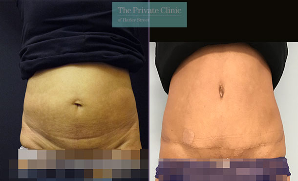 Tummy Tuck / Abdominoplasty - 011MB-Front