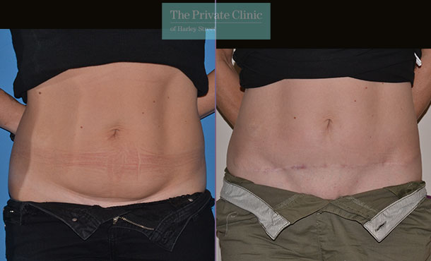 Tummy Tuck / Abdominoplasty - 056AR-Front