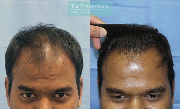 FUE Hair Transplant - 075RR