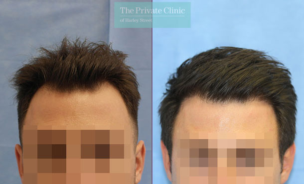 FUE Hair Transplant - 107RR-Front