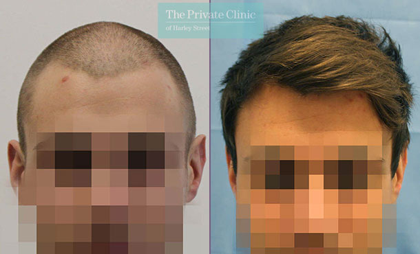 FUE Hair Transplant - 030RR