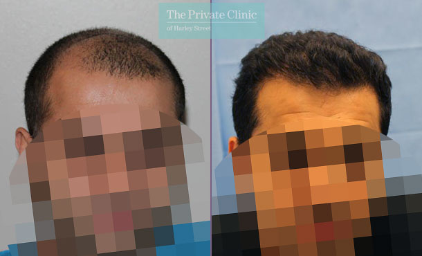 FUE Hair Transplant - 053RR