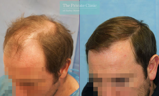 FUE Hair Transplant - 093RR-Side