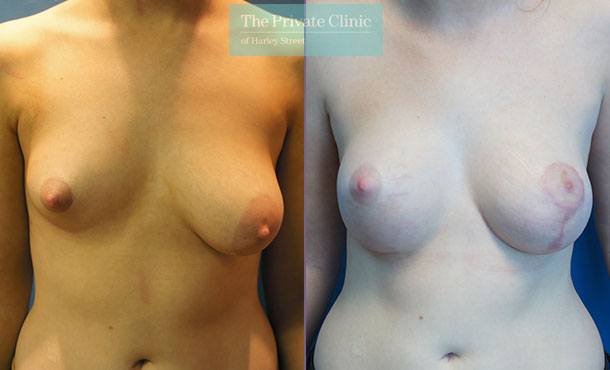 Breast Asymmetry - 058AR-Front