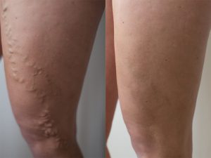 varicose vein evla before after 300x225 1