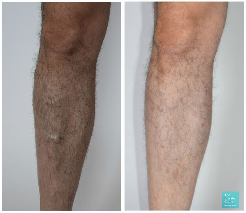 varicose vein removal surgery evla cost birmingham before after photos results 001