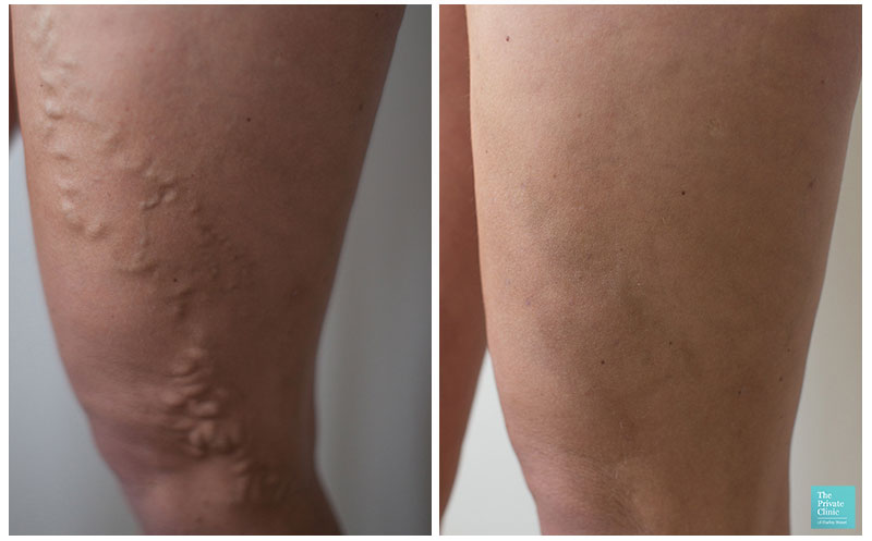 varicose vein removal surgery evla cost birmingham before after photos results 002