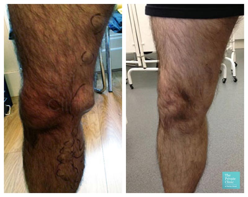 varicose vein removal surgery evla cost birmingham before after photos results 003