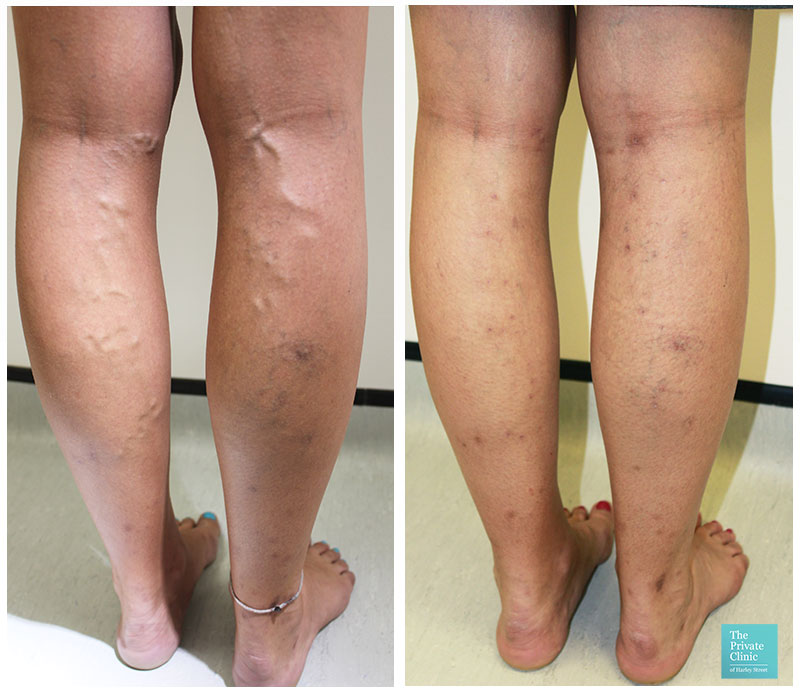 varicose vein removal surgery evla cost bristol before after photos results 001