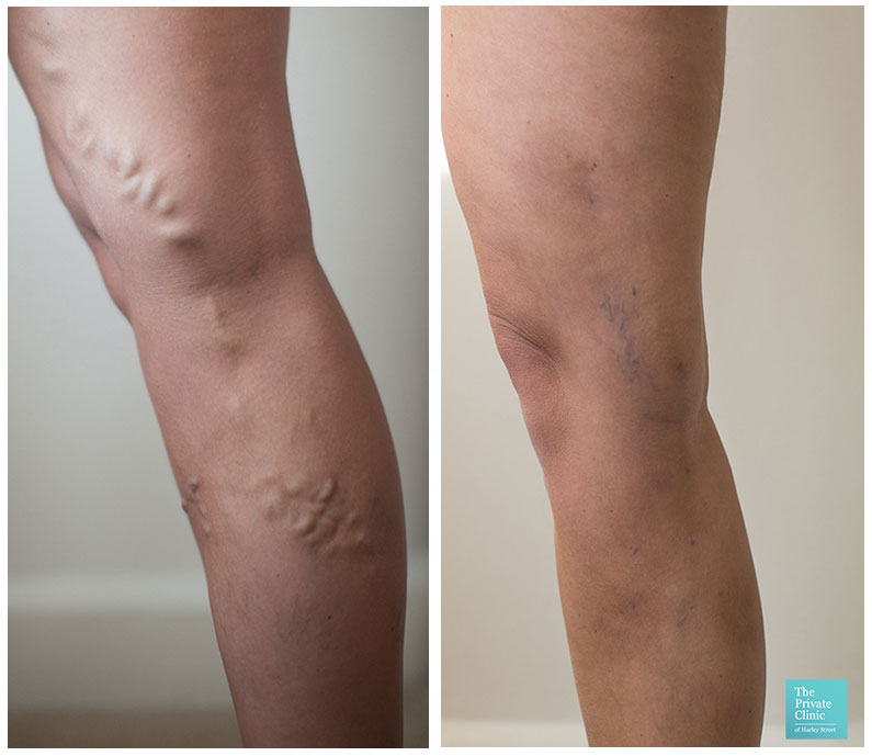 varicose vein removal surgery evla cost bristol before after photos results 002