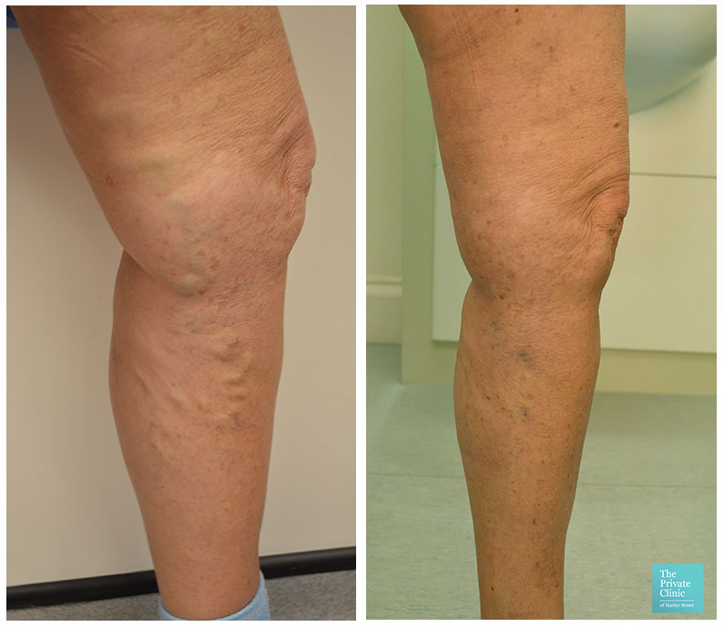 varicose vein removal surgery evla cost leeds before after photos results 001