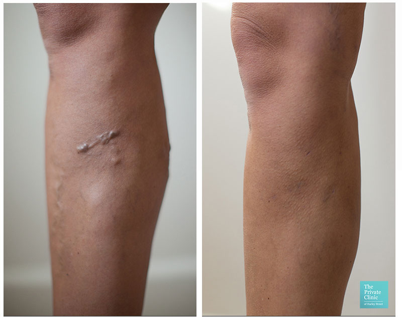 varicose vein removal surgery evla cost leeds before after photos results 004