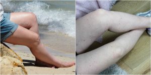 varicose veins evla jen before after photos patient story review
