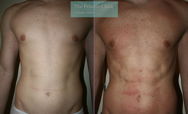 before and after photo of vaser lipo