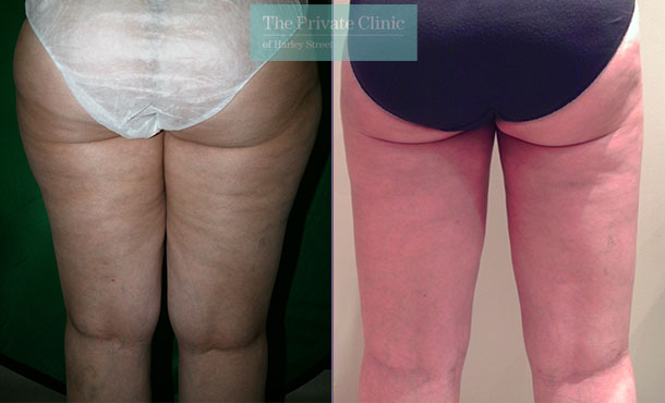 before and after photos of vaser lipo