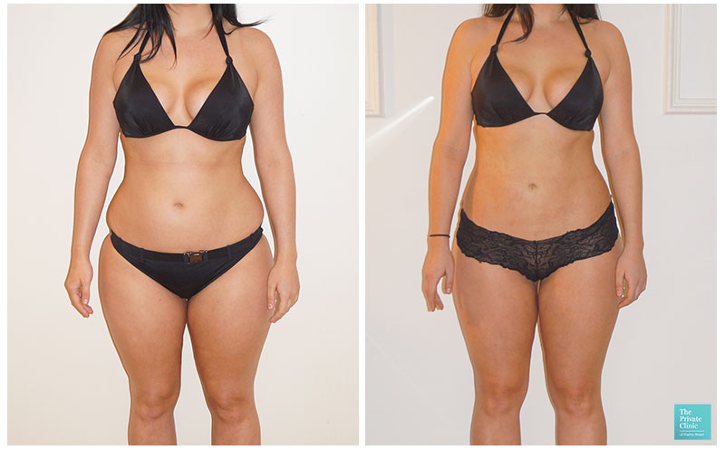 vaser liposuction female abdomen flanks thighs fat reduction removal before after results