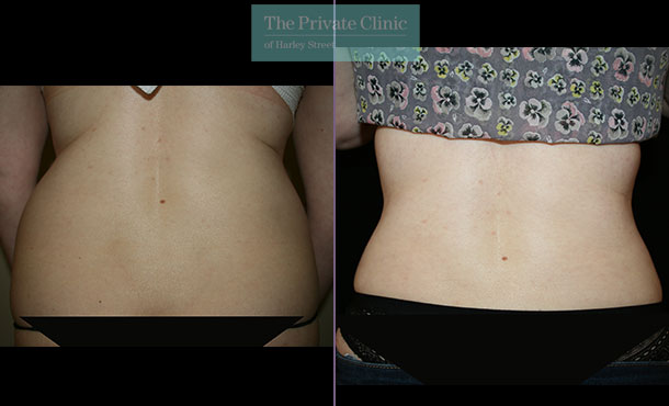 before and after photos of vaser lipo