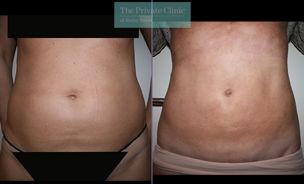 before and after photos of vaser lipo