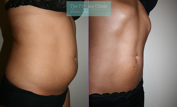 before and after photos of vaser lipo