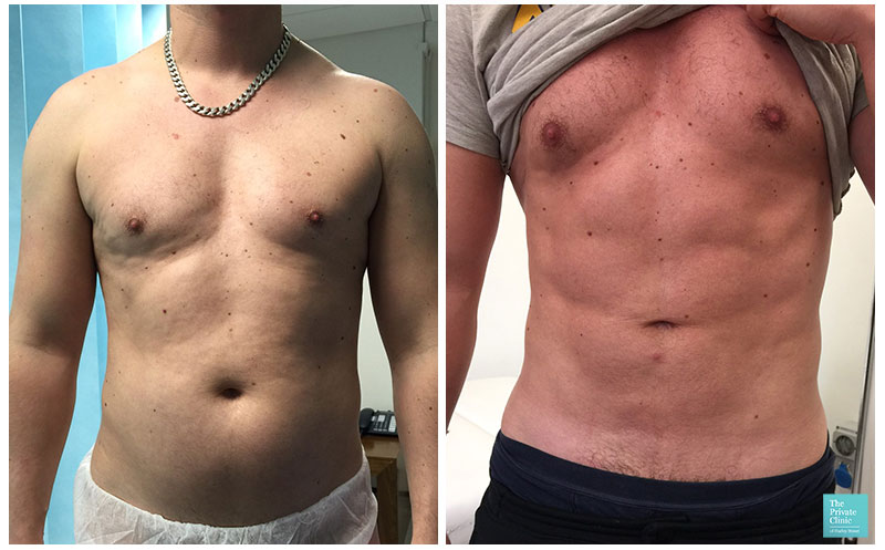 vaser liposuction male abdomen before after photo results the private clinic