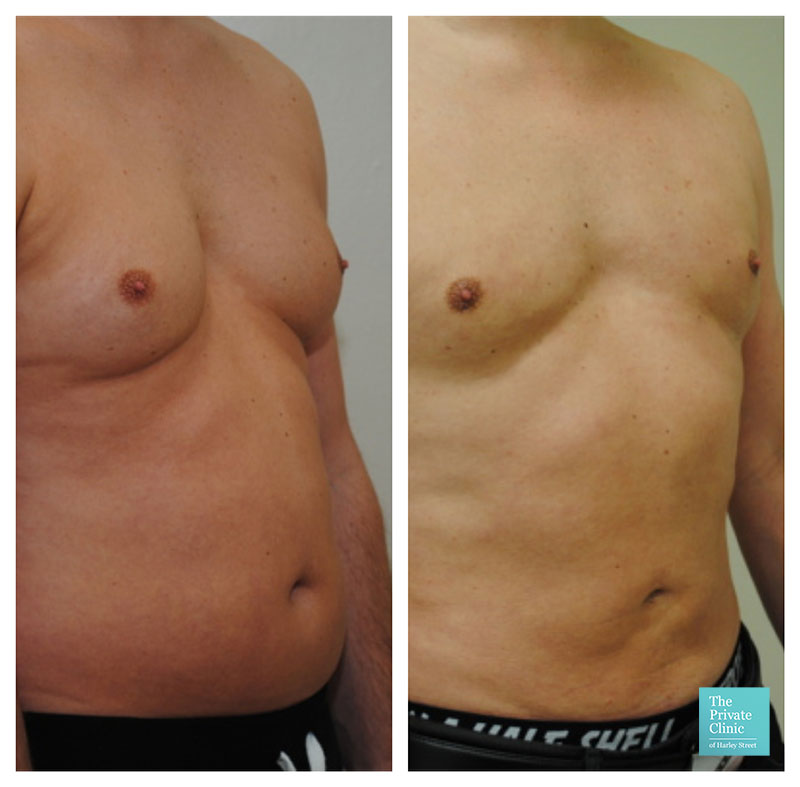 vaser liposuction male chest reduction abdomen tummy before after photo results the private clinic