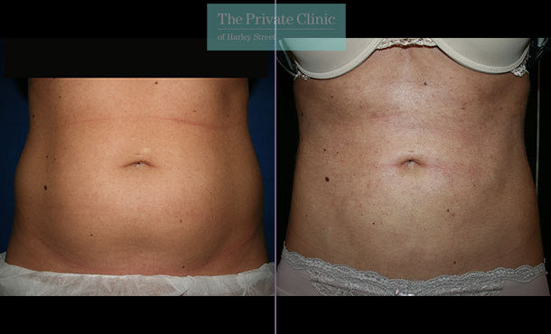 before and after photos of vaser lipo