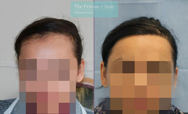 FUE Hair Transplant for Women - 041RR