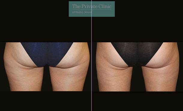 CoolSculpting - 010CP