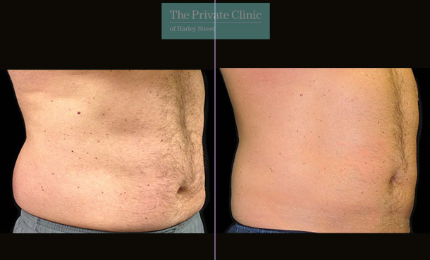 CoolSculpting - 028CP