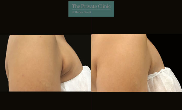 CoolSculpting - 005CP