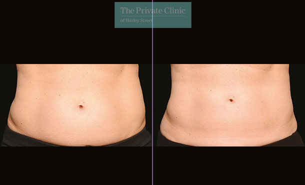 CoolSculpting - 001CP-Front