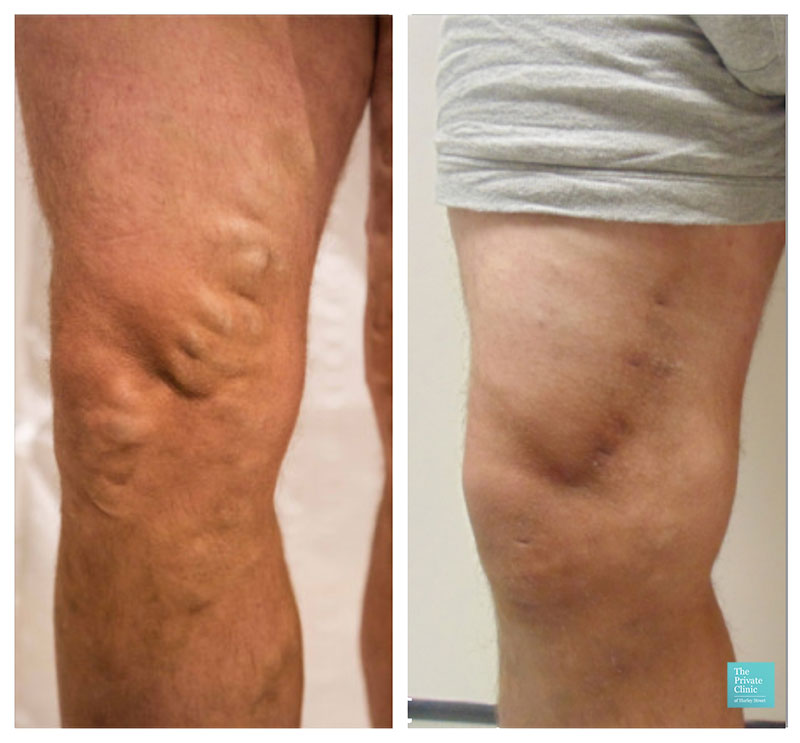 foam-sclerotherapy-before-and-after-results