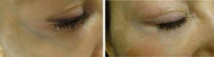 Veins under eyes before after photo