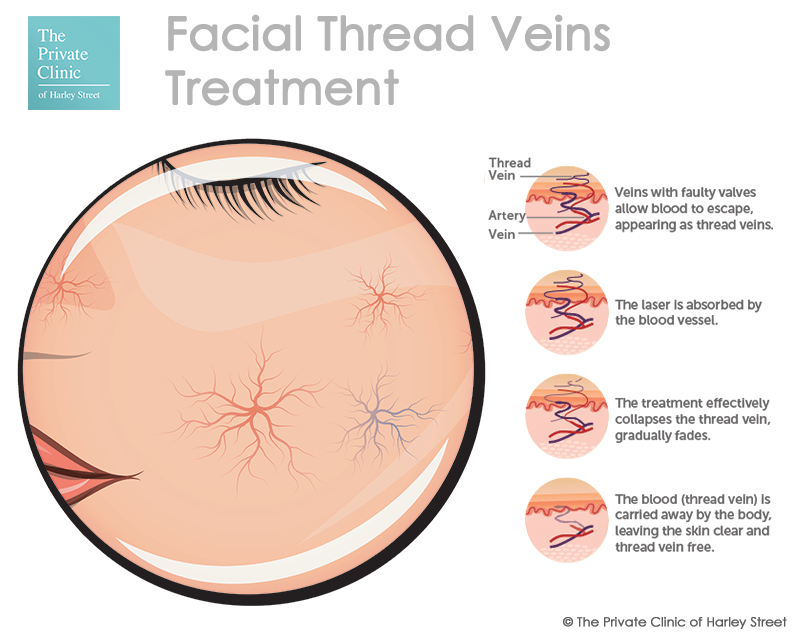 facial-veins-treatment-thread-veins-face-cutera-coolglide-ndyag-laser-treatment-web.png