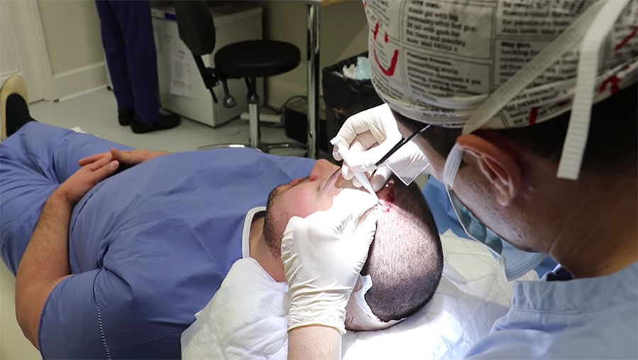 fue-hair-transplant-with-implanter-dhi